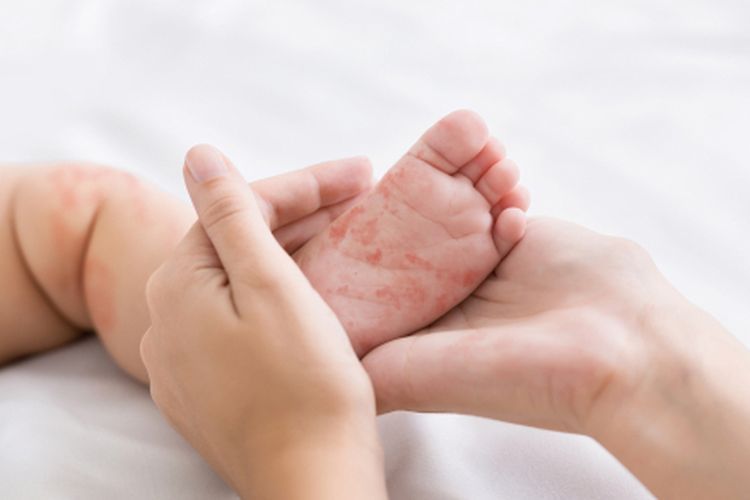 ilustrasi campak pada anak (Foto shutterstock)