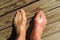 Ilustrasi kaki bengkak karena asam urat Foto: Cnick via Pixabay